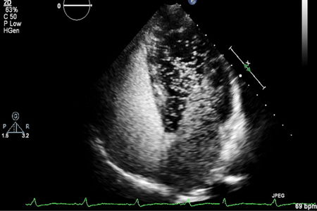 Agitated Saline Bubble Echocardiogram | SmartCare Diagnostics | Springfield & Mt. Gravatt